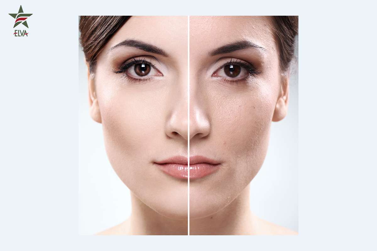 جوانسازی صورت در بندرعباس: بهترین خدمات کلینیک الوا