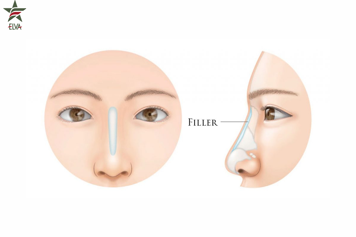 فیلر بینی مناسب چه کسانی است؟