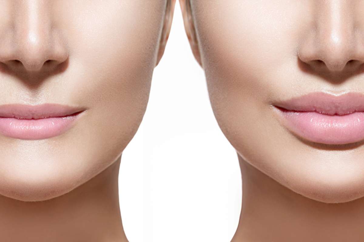 فیلر لب و گونه در بندرعباس