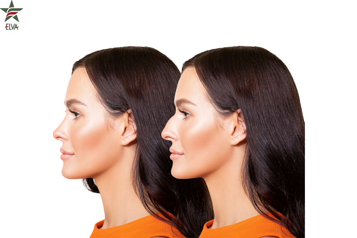 فیلر بینی: جایگزینی غیر جراحی برای رینوپلاستی