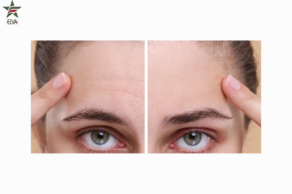 فیلر پیشانی: راهی برای از بین بردن چین و چروک عمیق