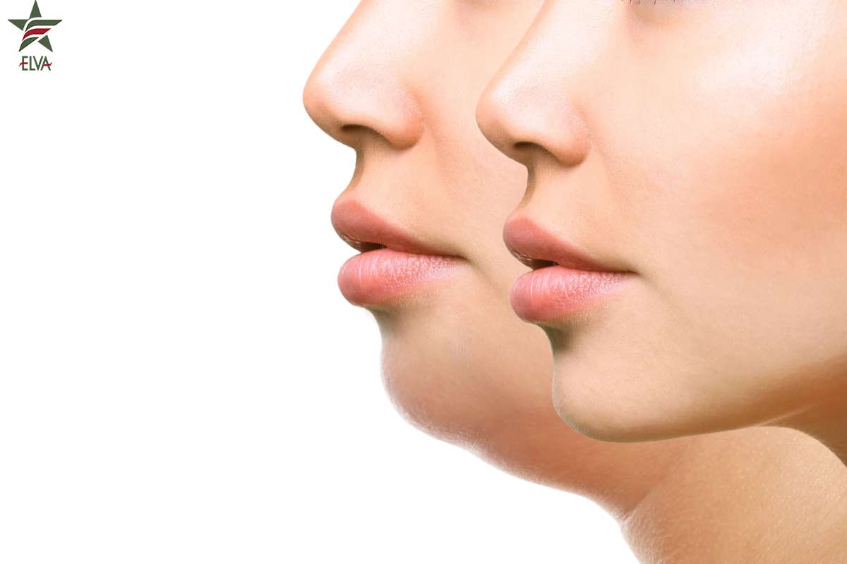 فیلر چانه: راهی برای برجسته سازی و فرم دهی به چانه بدون جراحی