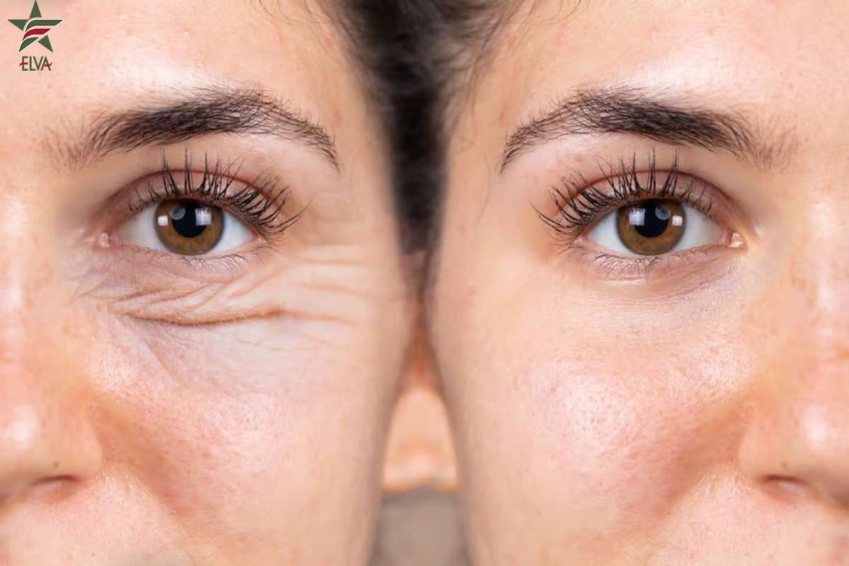 مقایسه فیلر چشم و جراحی پلک: کدام یک برای شما مناسب تر است؟