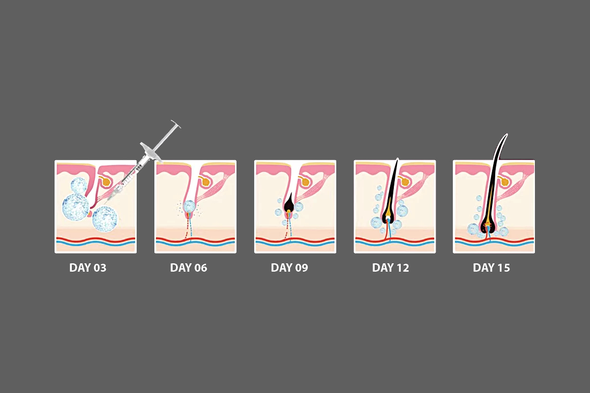 هیر فیلر چیست و چگونه به پرپشتی مو کمک می  کند؟