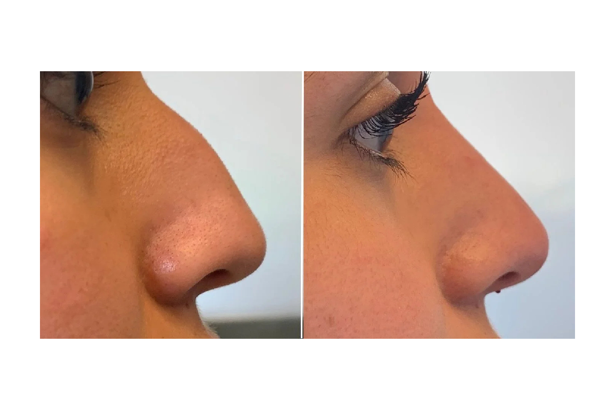 مراقبت  های قبل و بعد از فیلر بینی