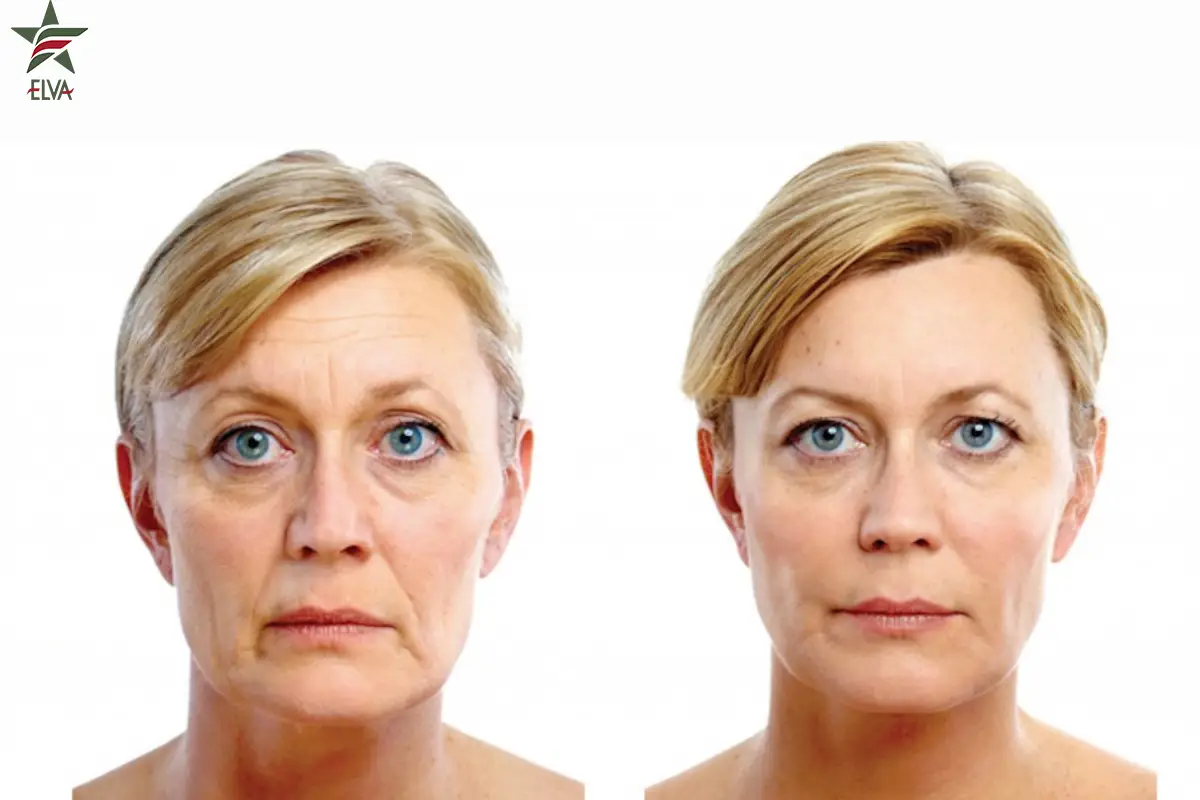 فیلر چگونه به جوانسازی پوست کمک می کند؟