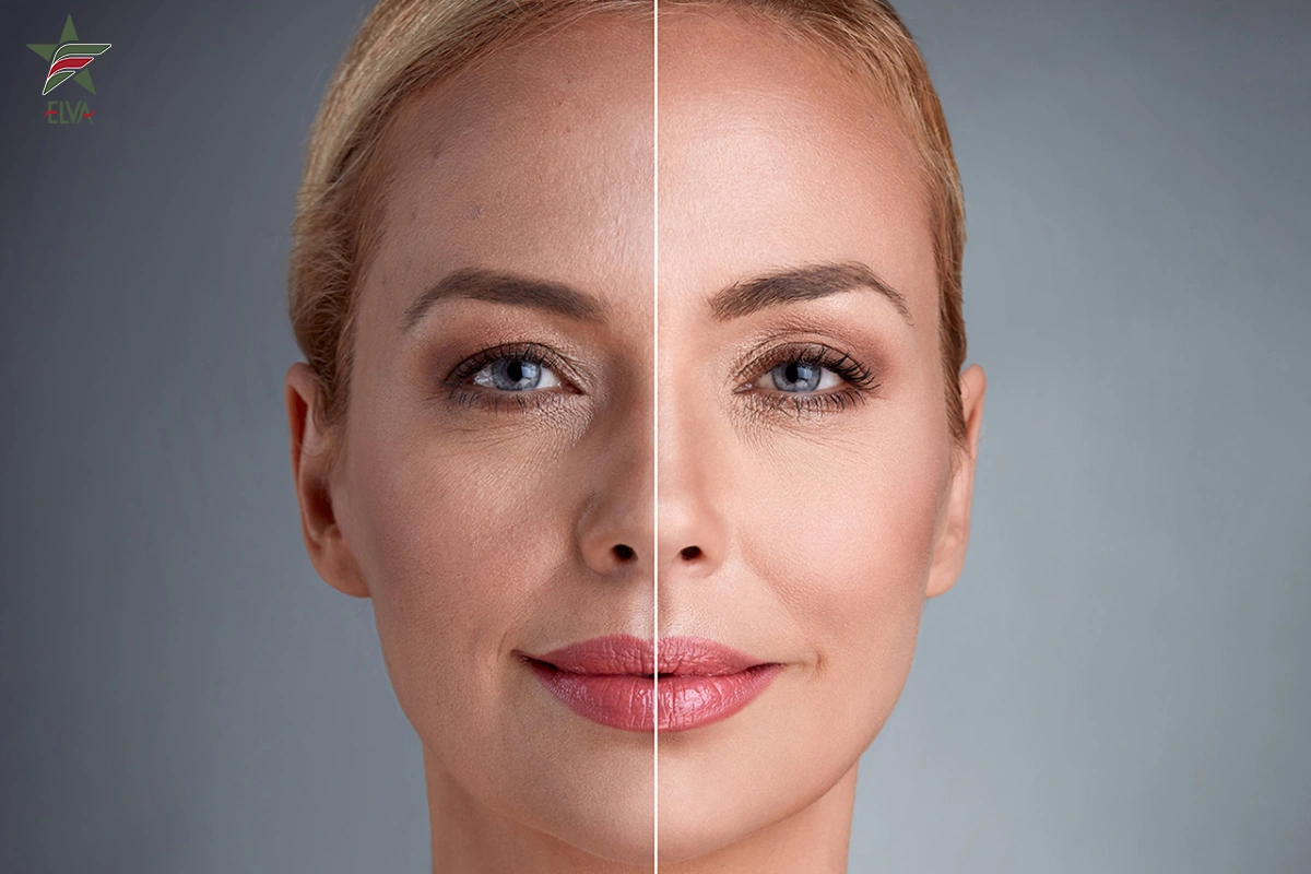 اندولیفت (Endolift): لیفت صورت با لیزر و بدون جراحی