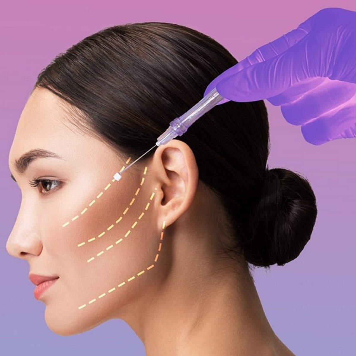 لیفت صورت با نخ