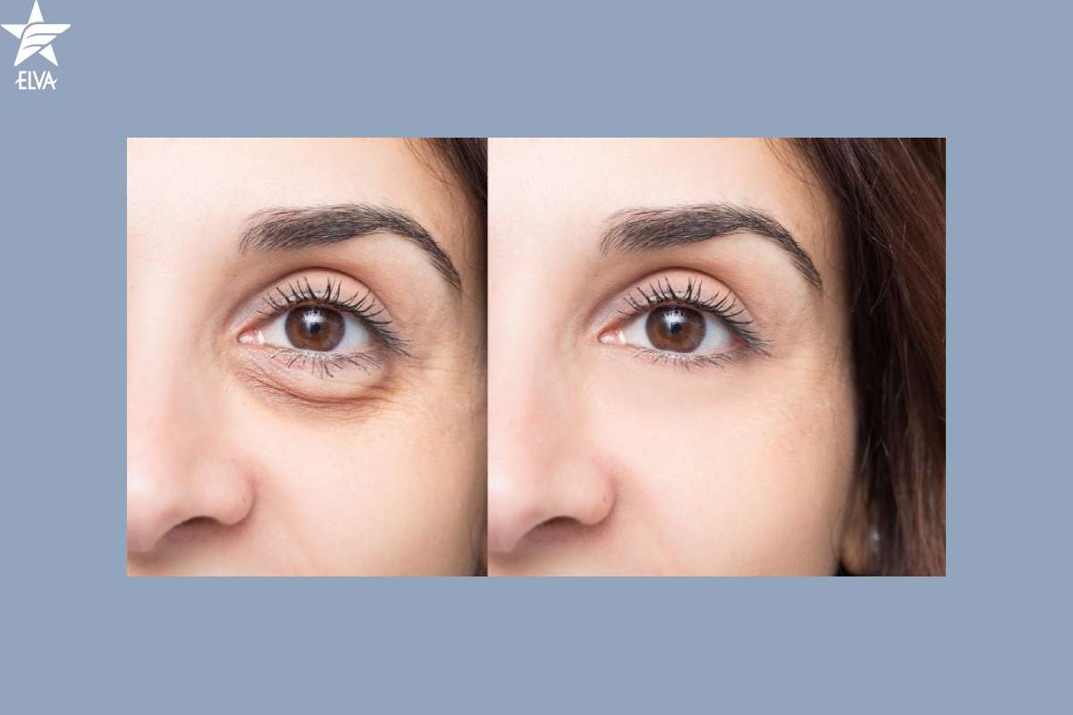 آیا فیلر زیر چشم دردناک است؟ پاسخ به سوالات رایج
