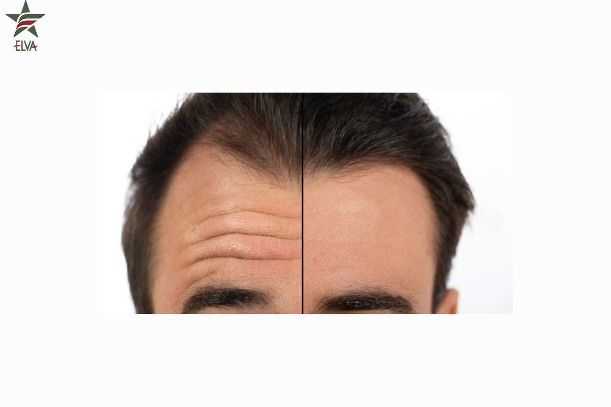 تفاوت فیلر پیشانی با بوتاکس چیست؟
