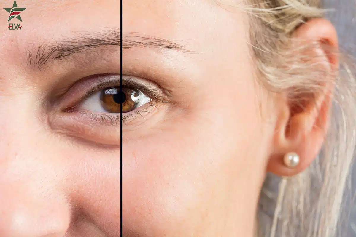 مزایای فیلر زیر چشم