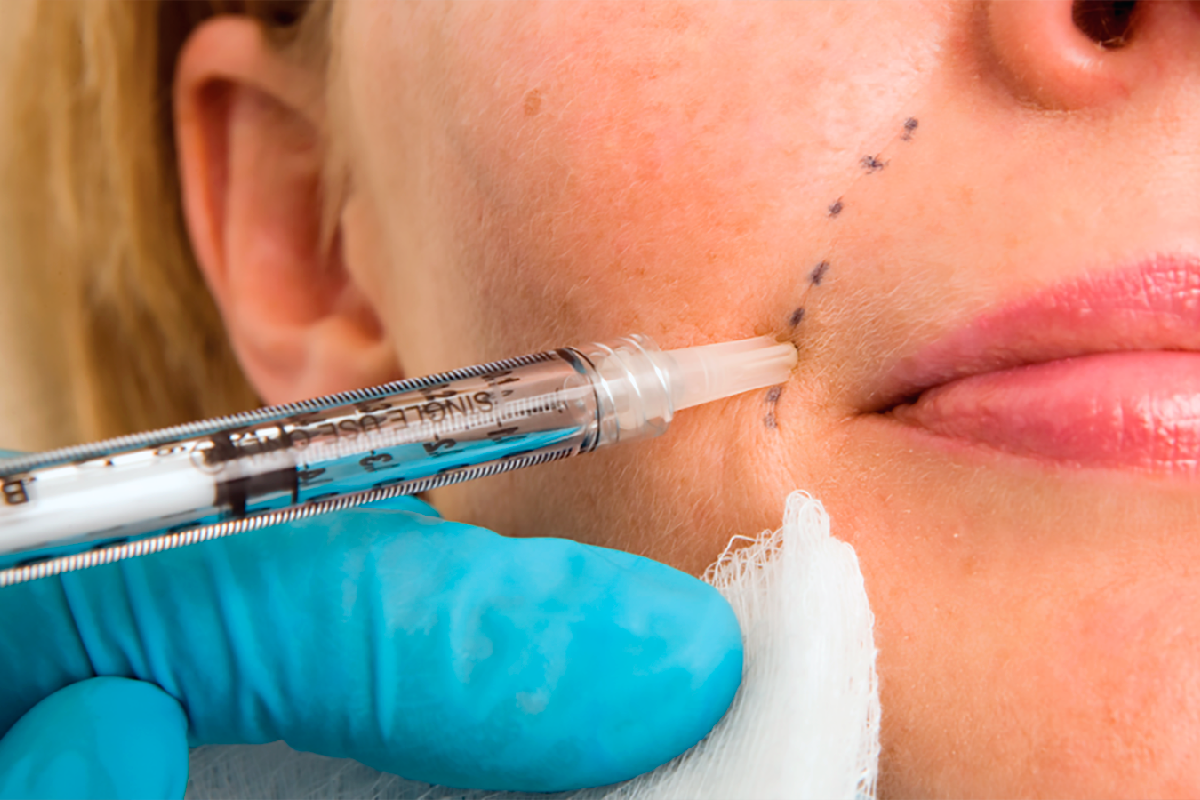 فیلرها چگونه عمل می کنند؟