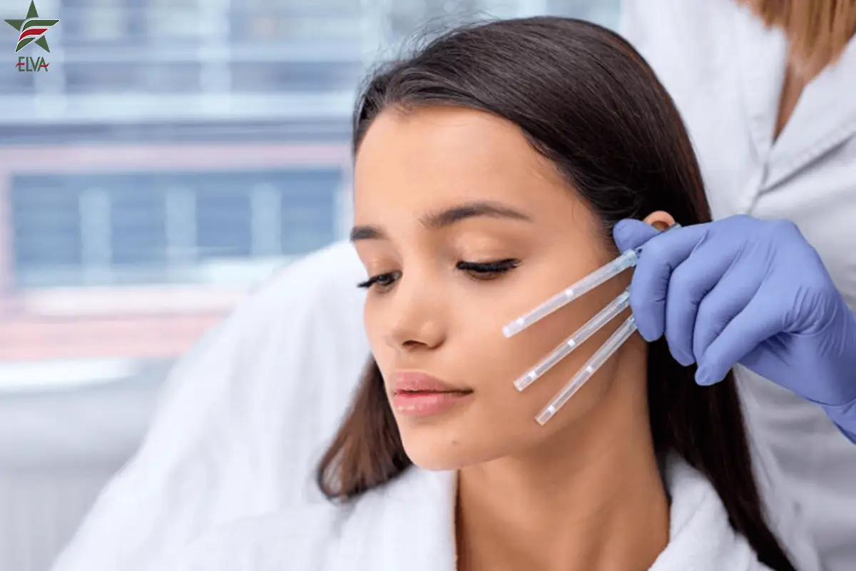 انواع نخ های لیفت و کاربرد آن ها