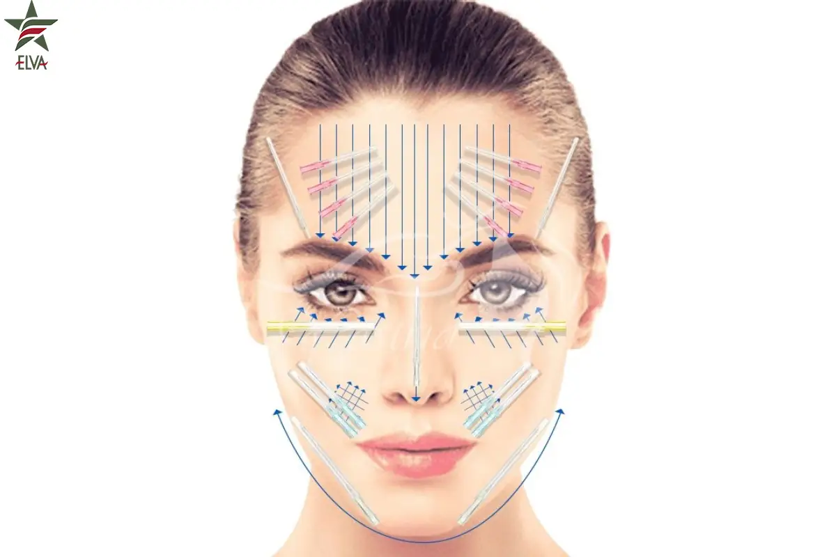 نواحی قابل درمان با نخ لیفت