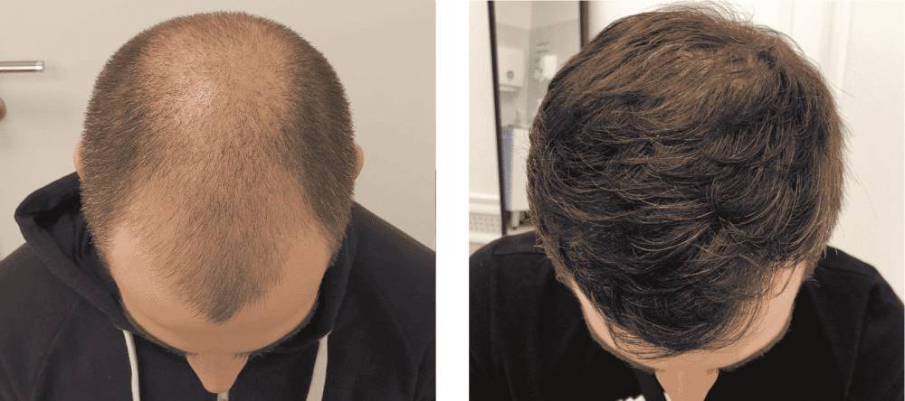 کاشت مو (Hair Transplantation): راهکار دائمی برای فولیکول های از دست رفته