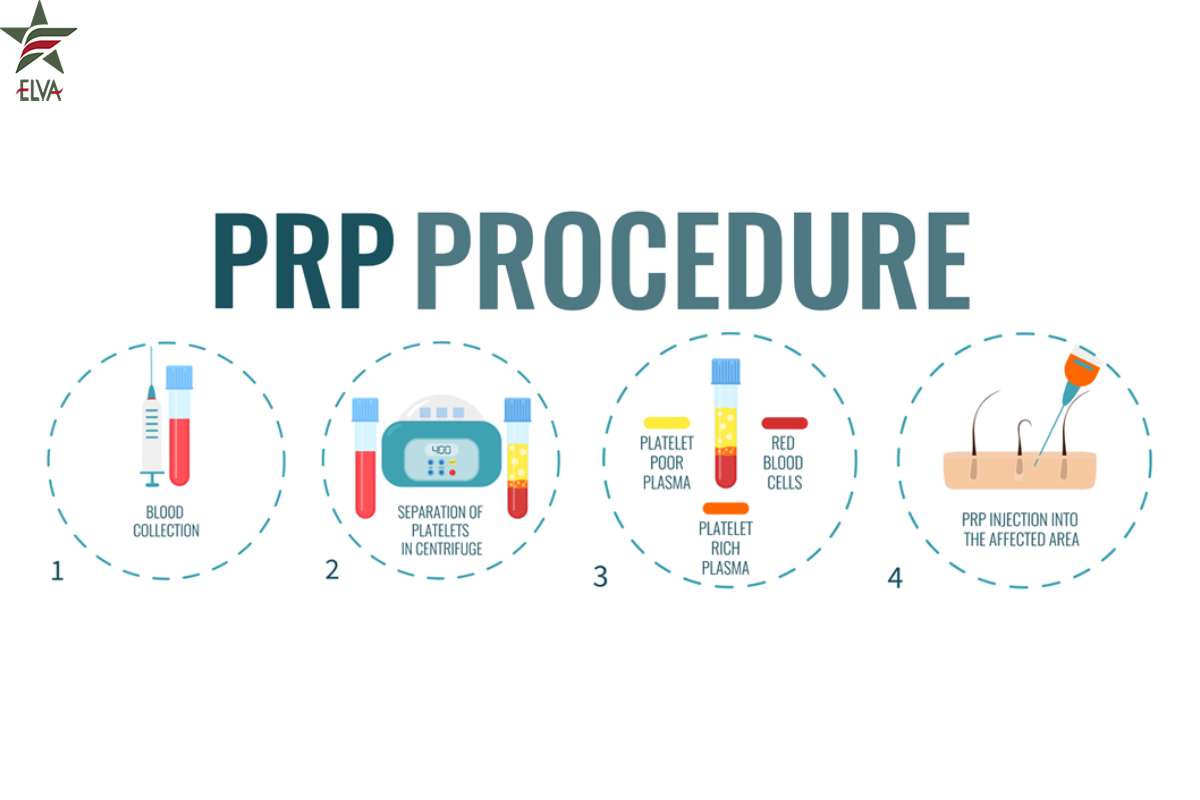 مراحل انجام PRP در کلینیک زیبایی الوا