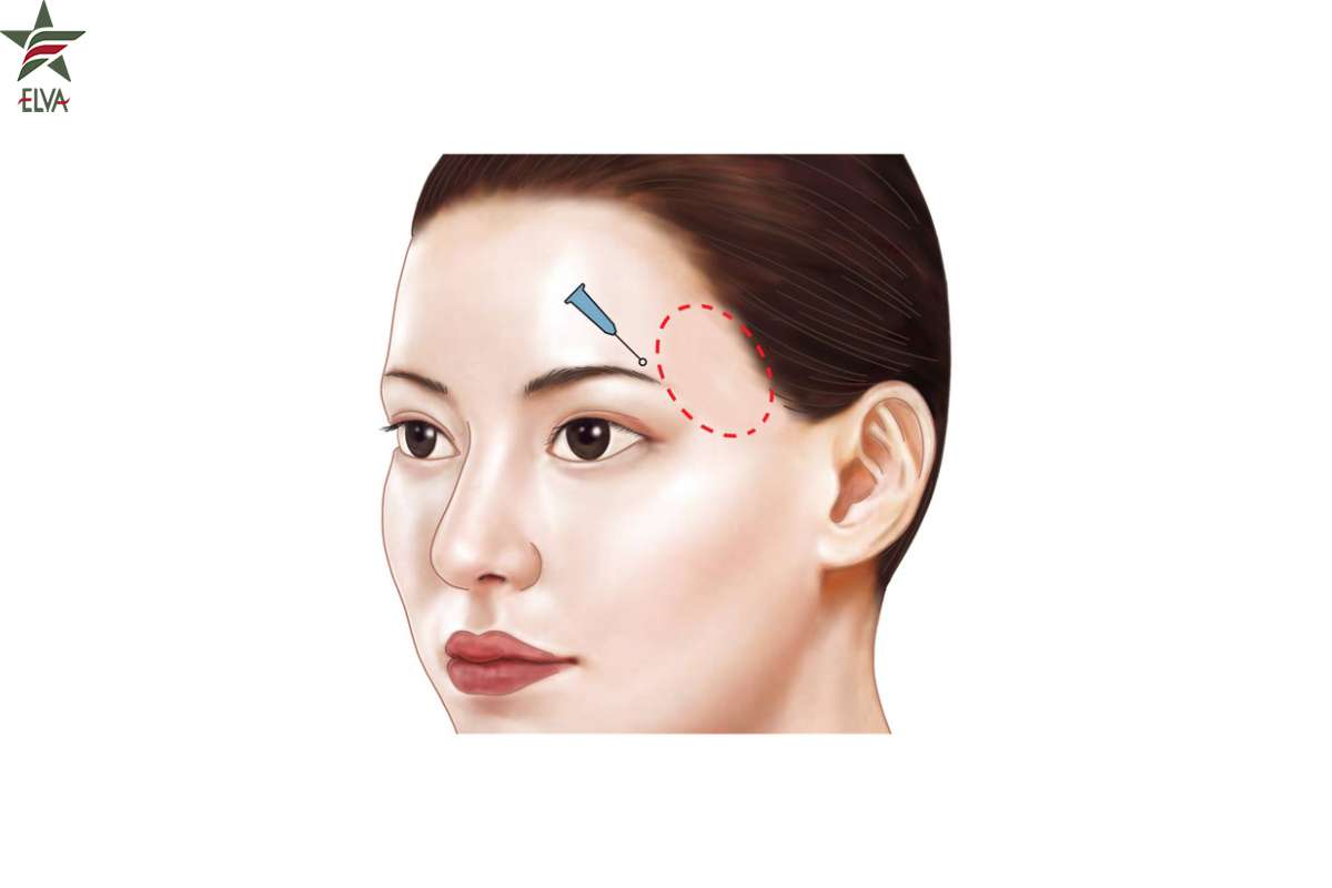 فرآیند تزریق فیلر شقیقه